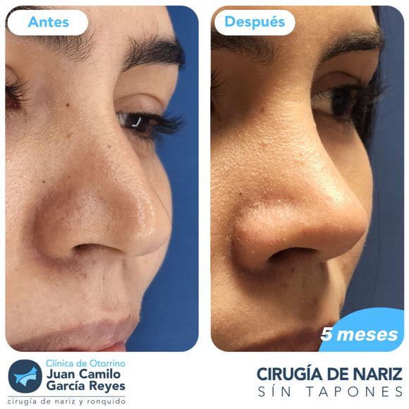 Antes y después de la rinoplastia, se muestra el perfil de la nariz del paciente. El después muestra una nariz refinada.