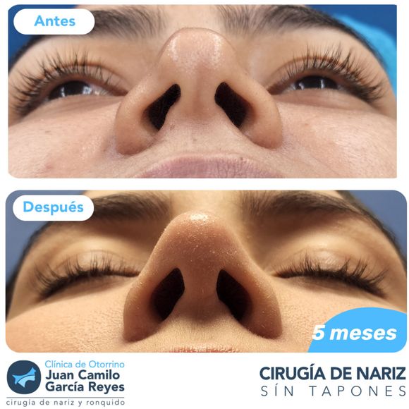 Comparación antes y después de la rinoplastia; la foto del después muestra una punta nasal refinada.