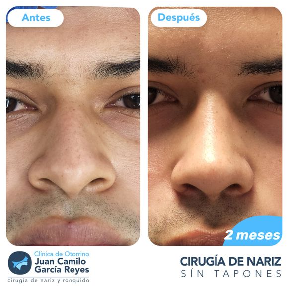 Fotografía del antes y el después de una rinoplastia. Se le ajustó la nariz a un hombre dos meses después de la cirugía.