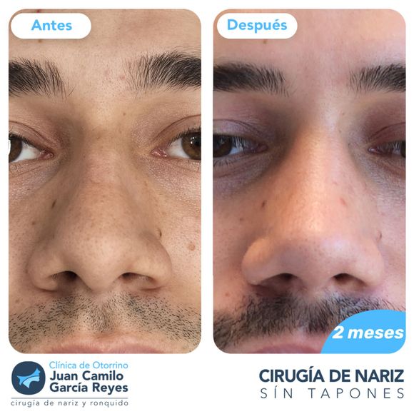 Comparación del antes y el después de una rinoplastia. La forma de la nariz del hombre está alterada.