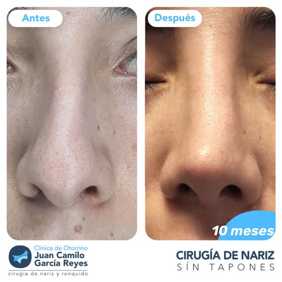 Antes y después de la rinoplastia, con la foto del 