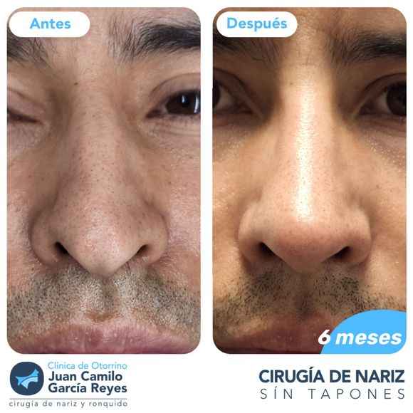 Comparación, antes y después, del resultado de una cirugía de nariz en el rostro de un hombre.