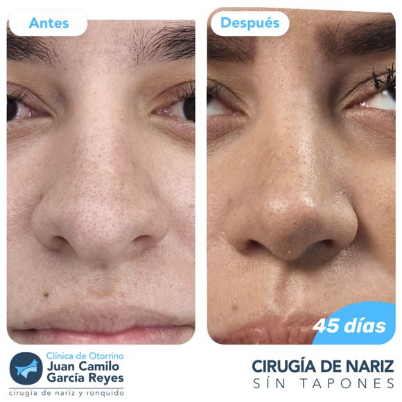 Comparación: “Antes” y “Después” de una rinoplastia en la nariz de una mujer; 45 días después de la cirugía.