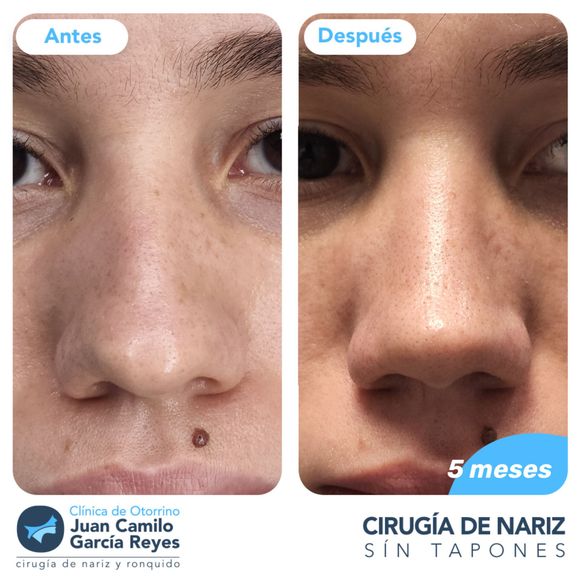 Comparación de la nariz de una persona antes y después de una rinoplastia, 5 meses después de la cirugía.