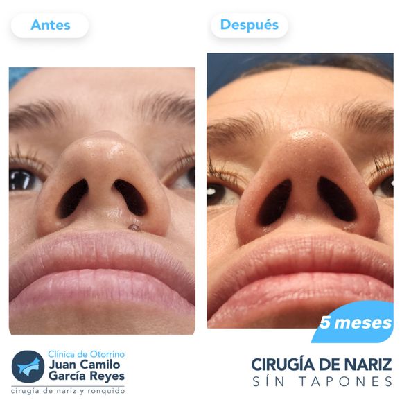 Comparación de una nariz antes y después de la cirugía, con leyenda 