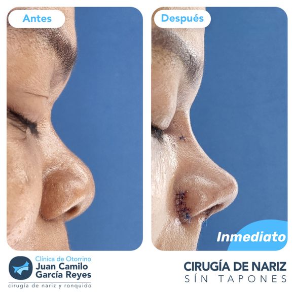 Fotografías una al lado de la otra que muestran una nariz antes e inmediatamente después de la rinoplastia.