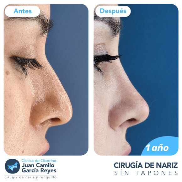 Fotos antes y después de rinoplastia; nariz de mujer remodelada; piel blanca, fondo azul.
