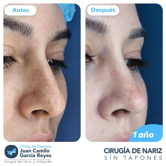 Comparación de una nariz antes y después de la rinoplastia, mostrando una nariz afinada un año después de la cirugía.