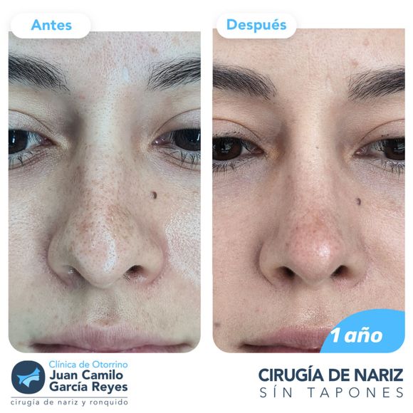 Comparación de imágenes divididas del rostro de una mujer antes y después de una rinoplastia (cirugía de nariz). 
