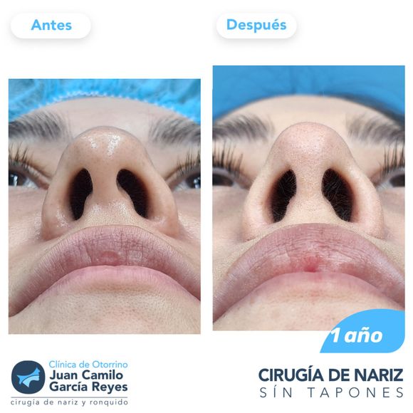 Comparación de una nariz antes y después de una rinoplastia; fosas nasales más pequeñas y definidas.