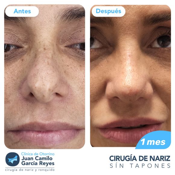 Comparación del rostro de una mujer antes y después de una rinoplastia. El 