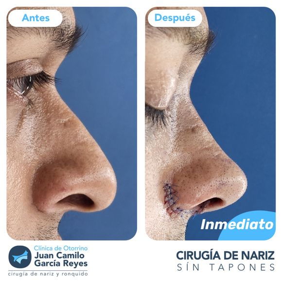 Comparación lado a lado de la nariz de un hombre antes y después de la cirugía de rinoplastia; fondo azul.