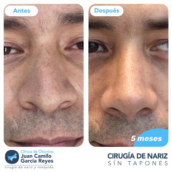Fotos comparativas del rostro de un hombre, antes y después de una rinoplastia. Se aprecia el cambio en la forma de la nariz.