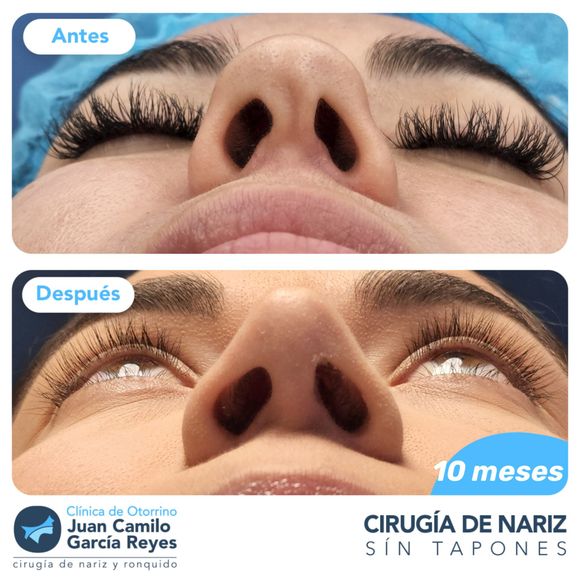 Antes y después de la rinoplastia. El 