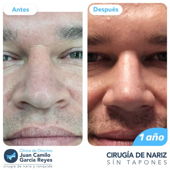 Antes y después de la rinoplastia: rostro de hombre; después de la cirugía, se remodela la nariz, un año después.