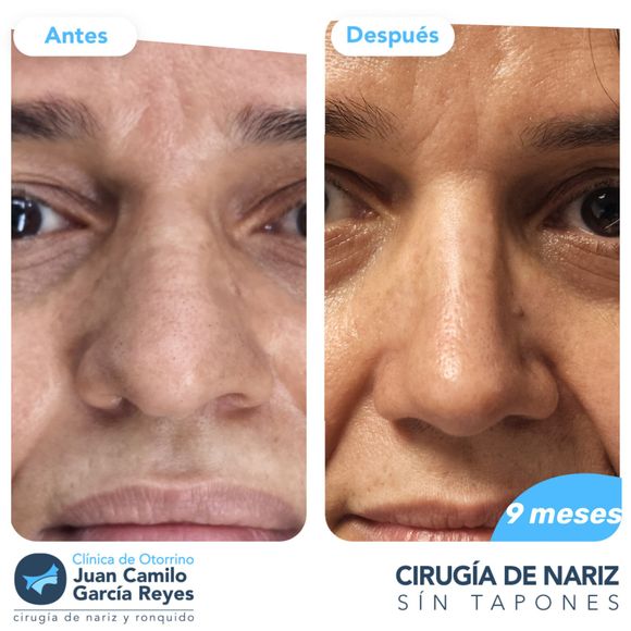 Comparación lado a lado del rostro de una persona antes y después de una rinoplastia.