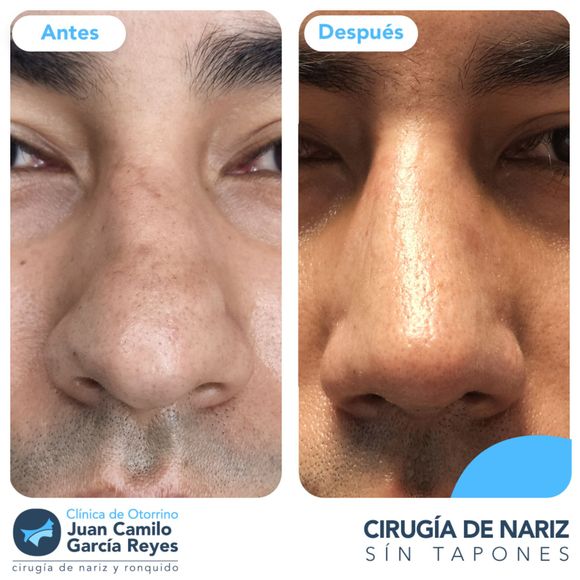 Fotos comparativas de la nariz de un hombre antes y después de una rinoplastia.