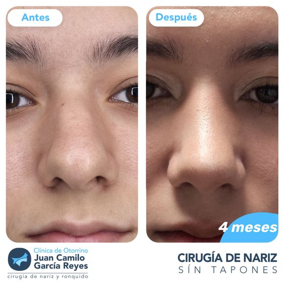 Comparación de la nariz de una persona antes y después de una rinoplastia. 