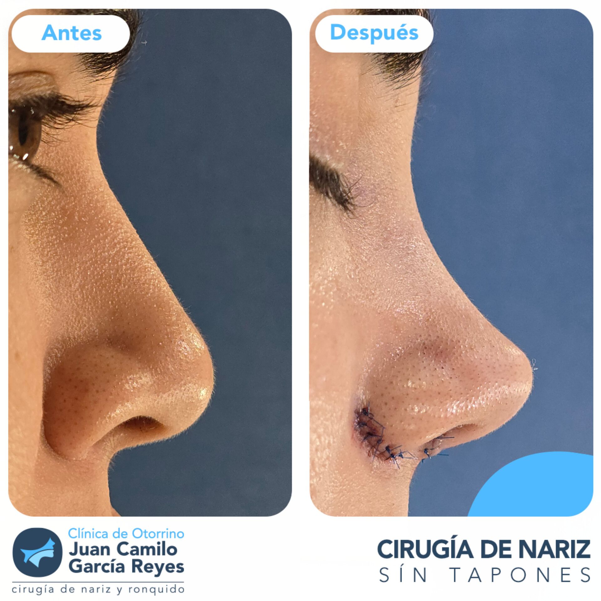 Comparación de una nariz antes y después de un tratamiento para el cuidado de la piel.