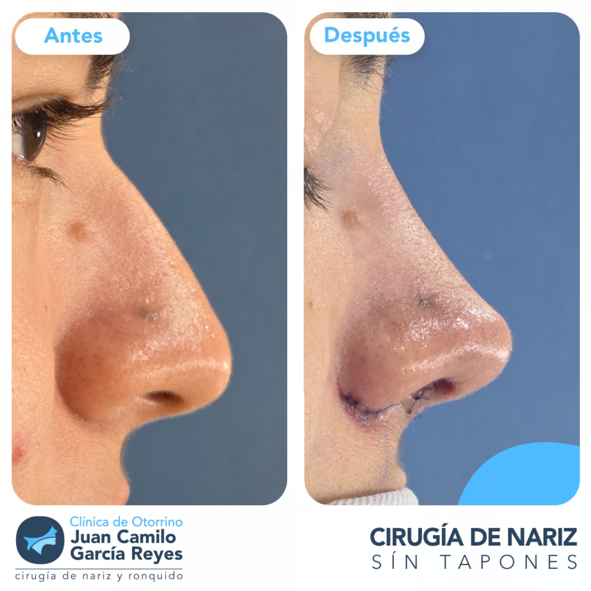 Fotografías de antes y después de una rinoplastia que muestran una vista de perfil de una nariz sobre un fondo azul liso.