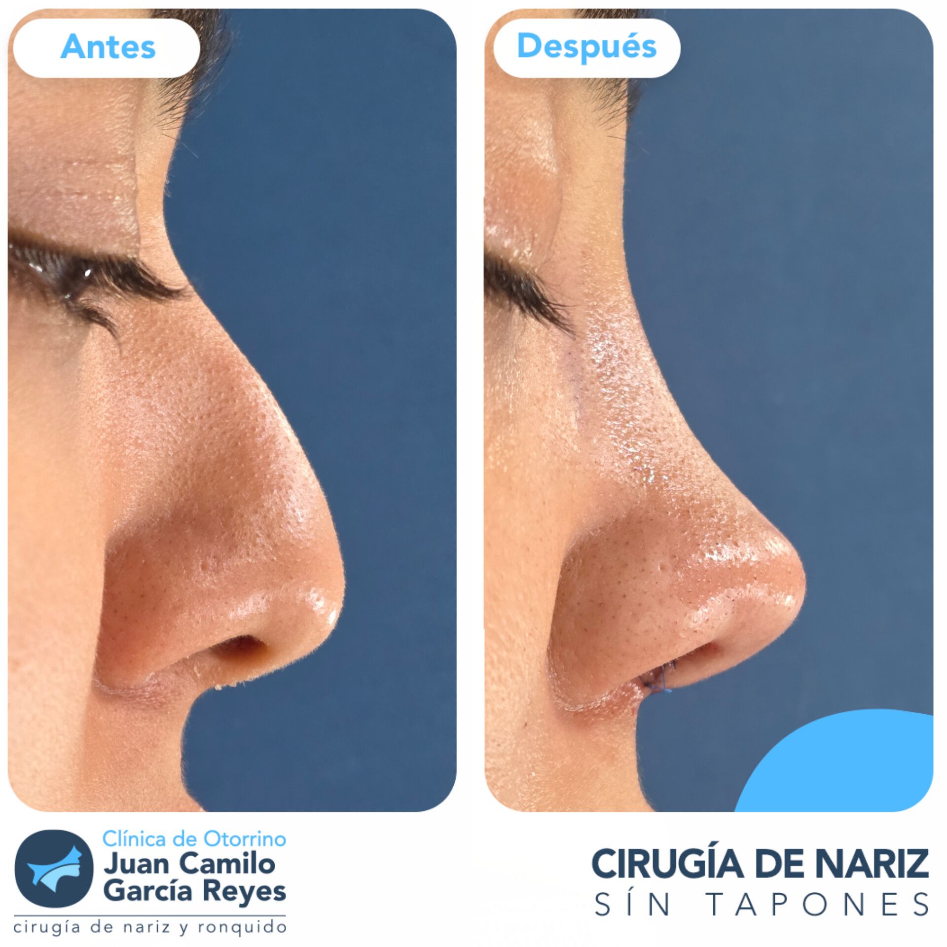 Comparación de una nariz antes y después de un tratamiento para el cuidado de la piel.