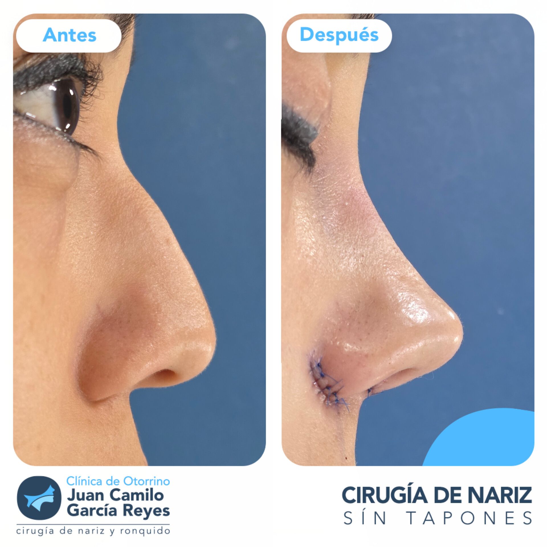 Comparación de una nariz antes y después de un tratamiento para el cuidado de la piel.