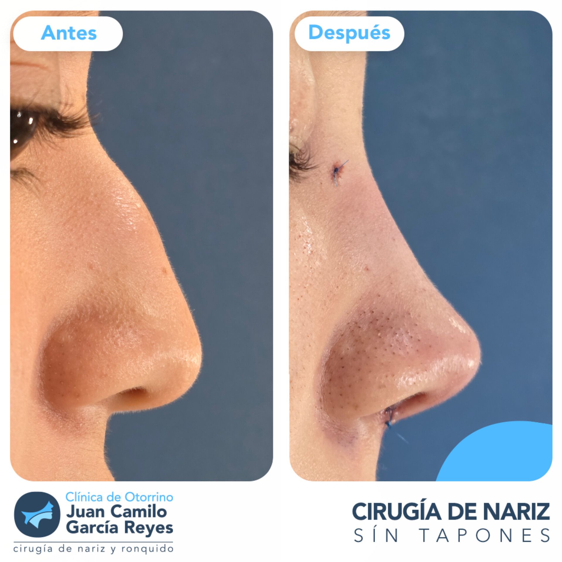 Vista de perfil antes y después de una rinoplastia, que muestra un puente nasal más liso y una punta más refinada.