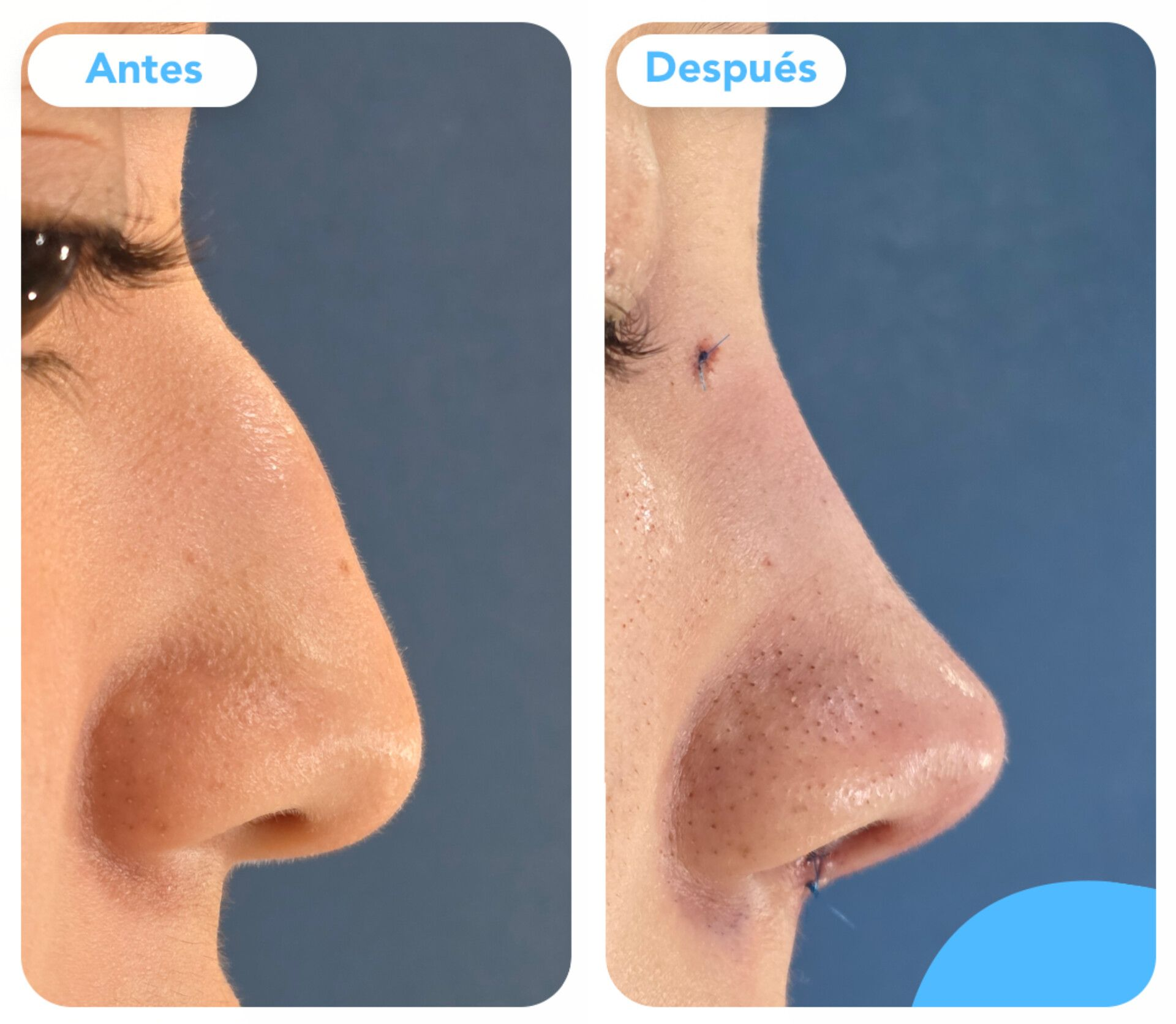 Comparación en primer plano de la nariz antes y después, con una mejora en la textura y el brillo de la piel.