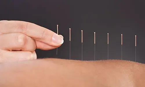 Needles on the Skin — Clearwater, FL — Pain Care Management