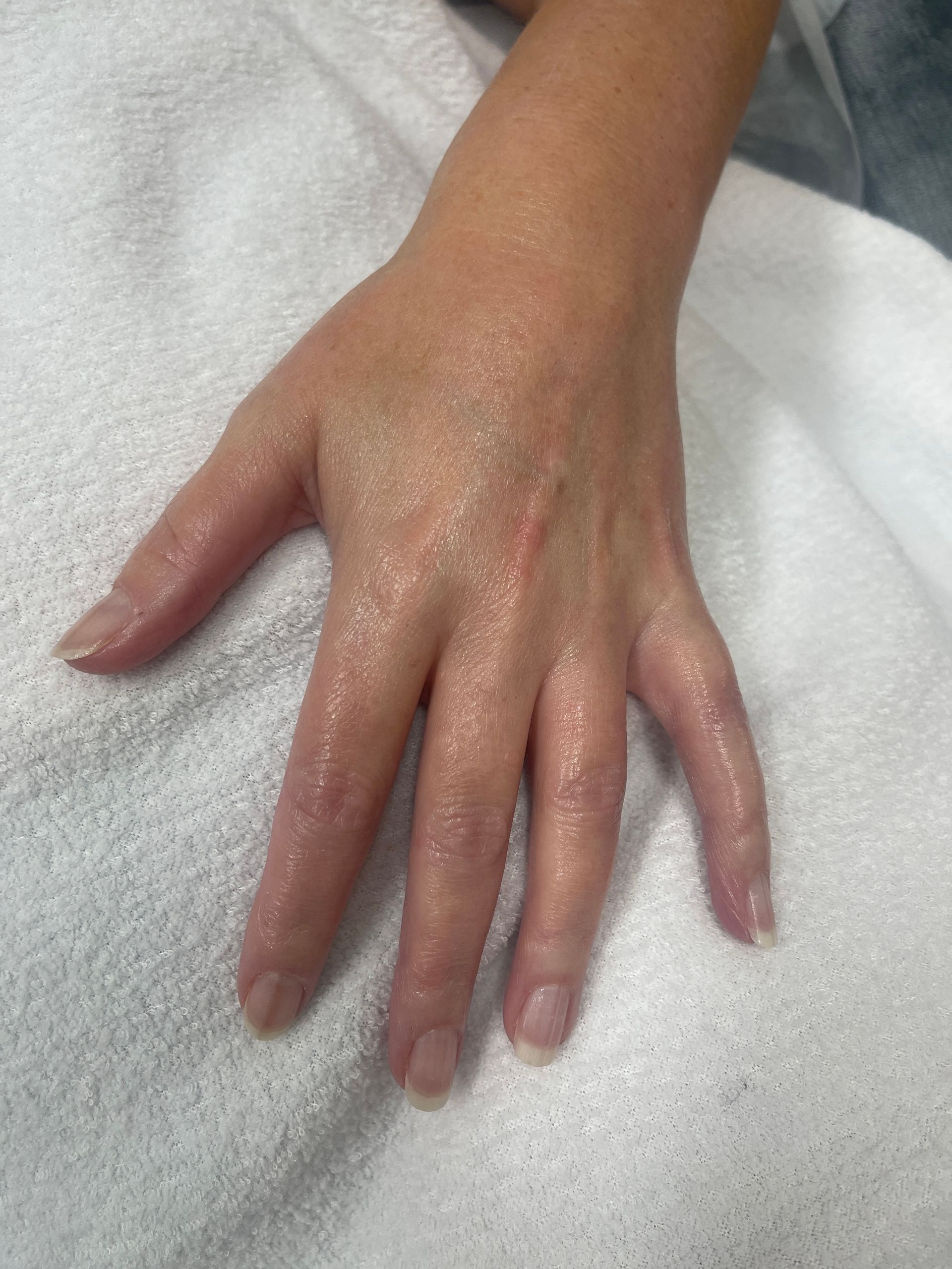 IPL Treatment 