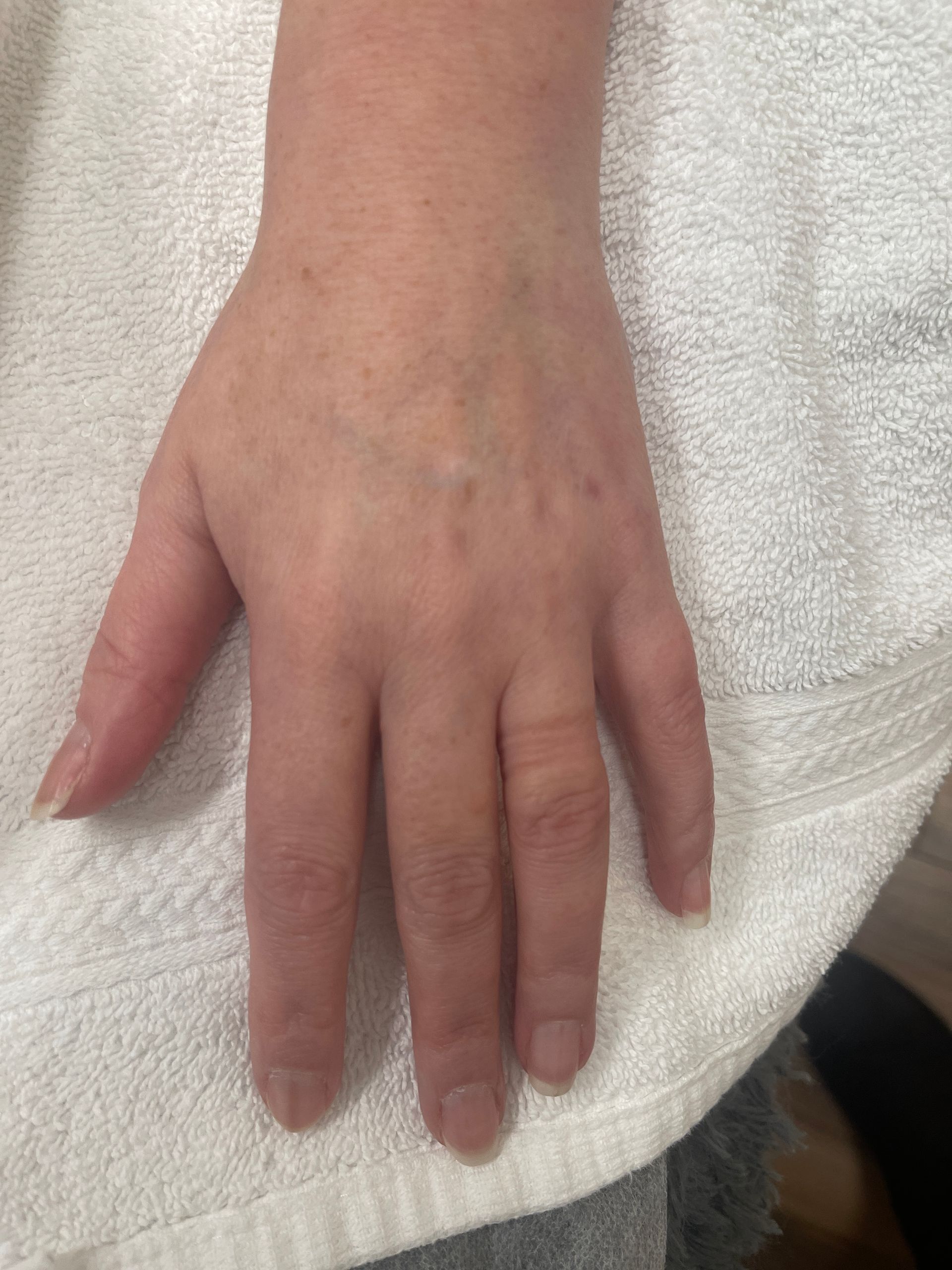 IPL Treatment 
