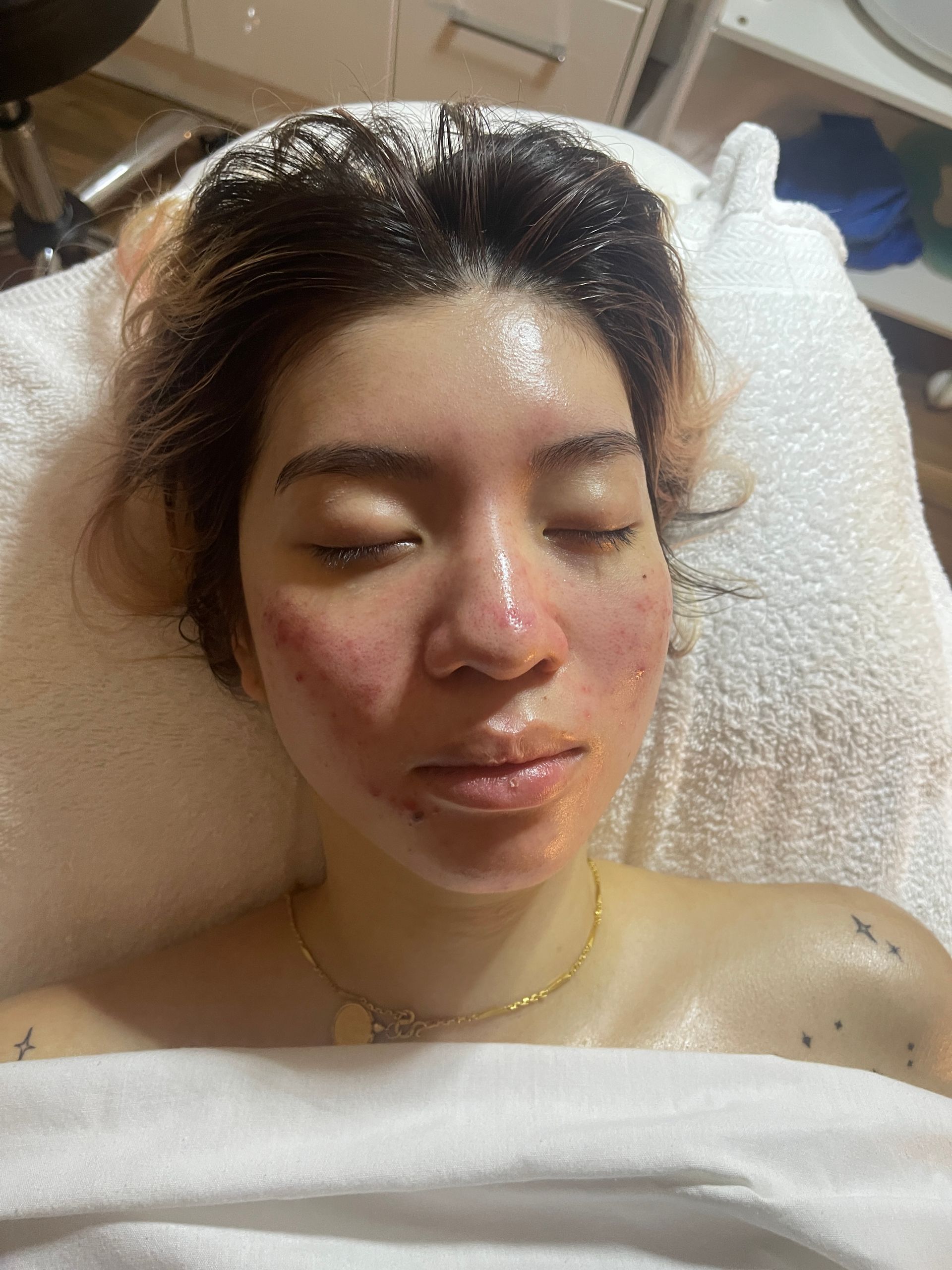 facial treatment