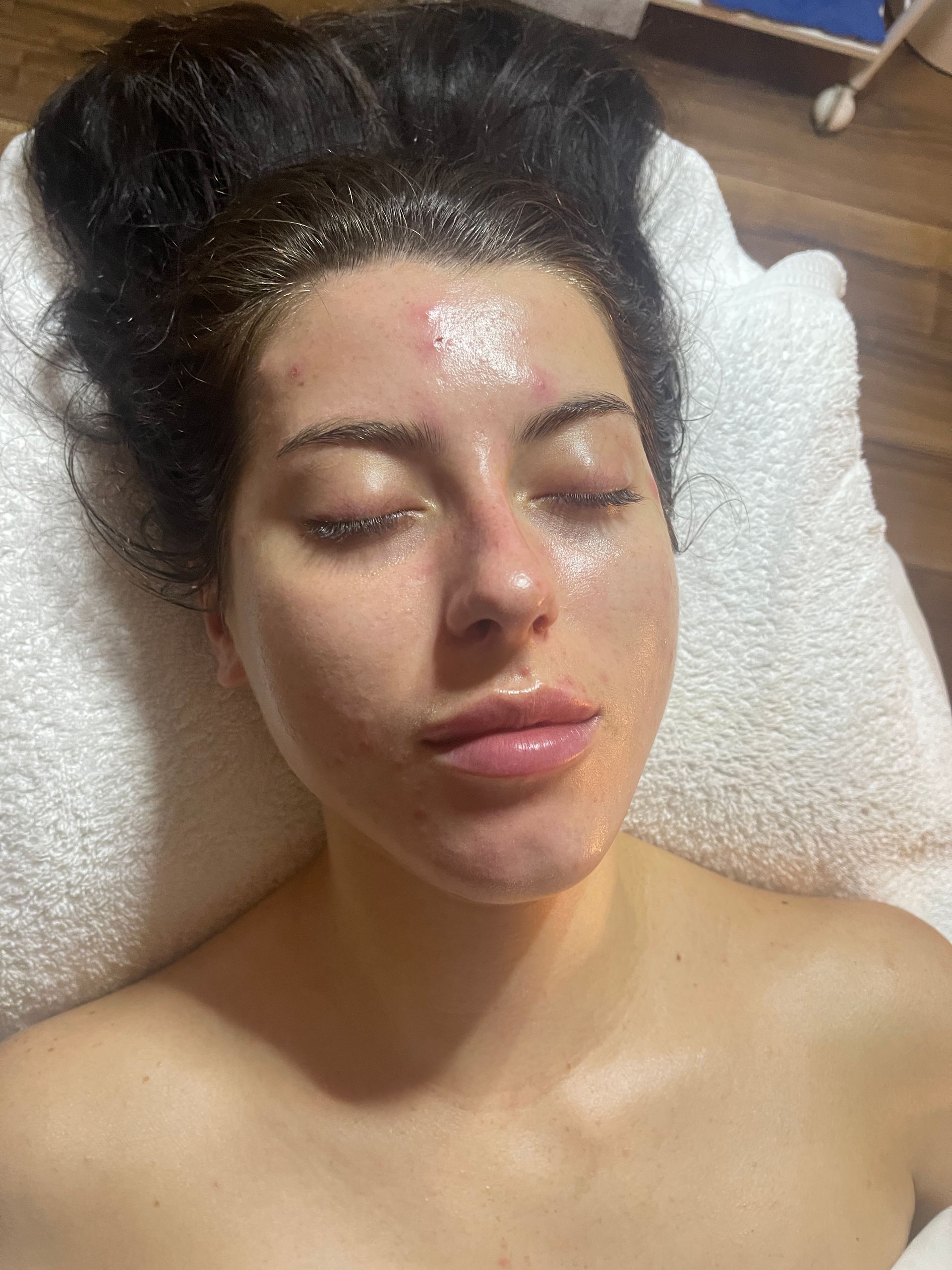 facial treatment