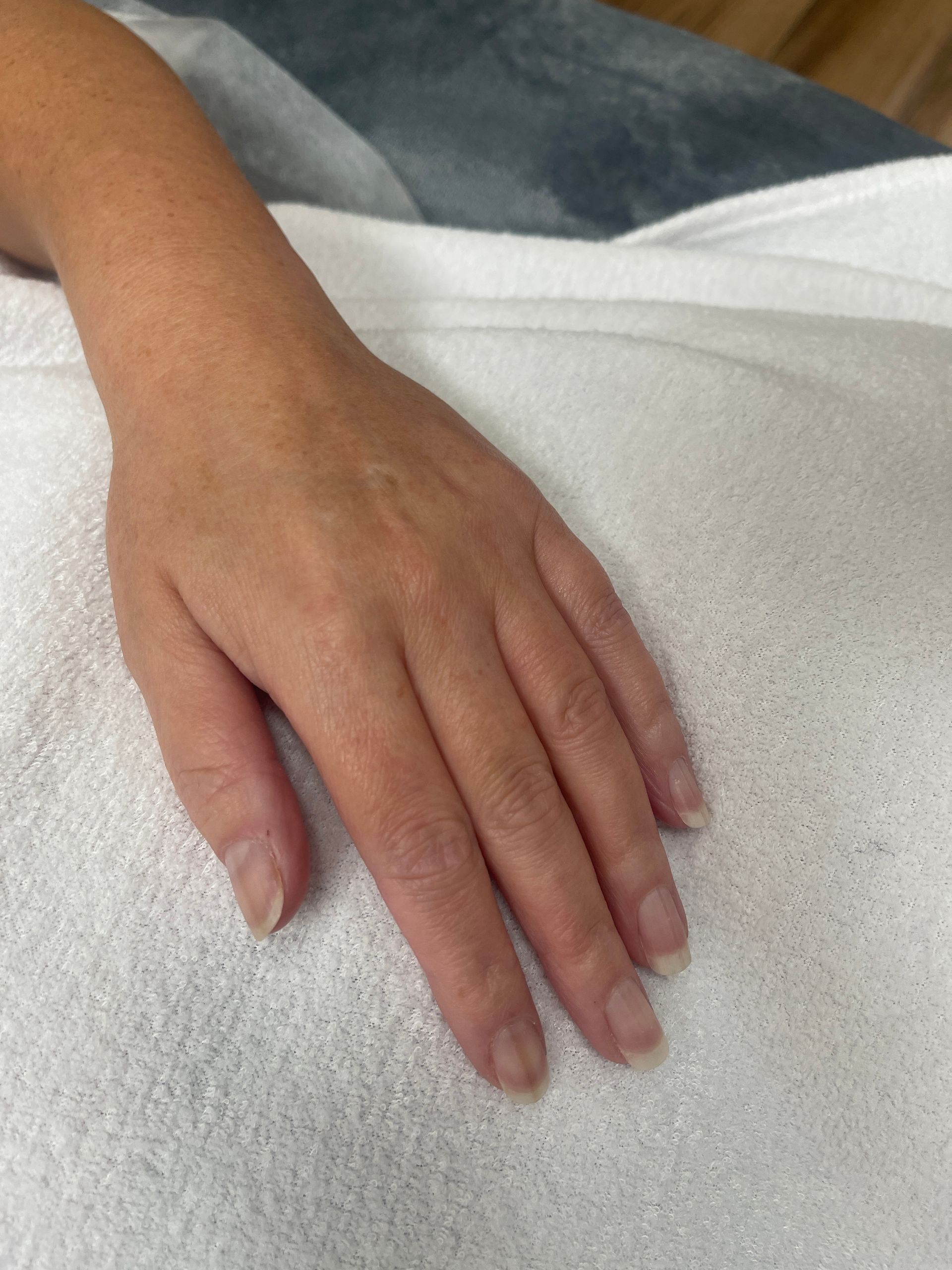 IPL Treatment 