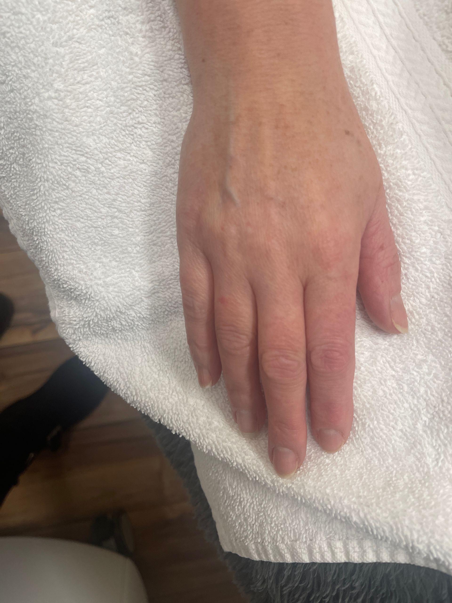 IPL Treatment 