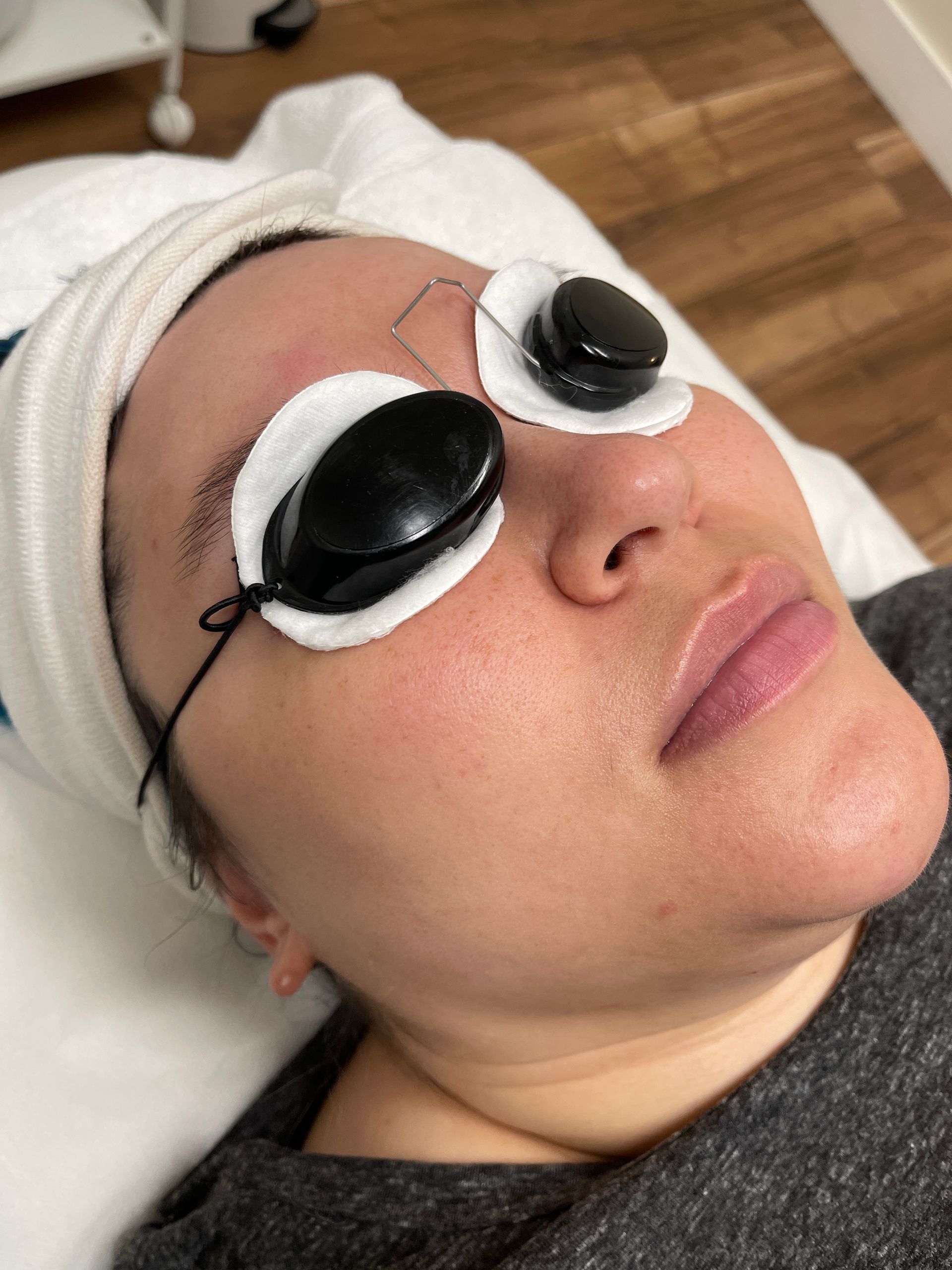 IPL Treatment 
