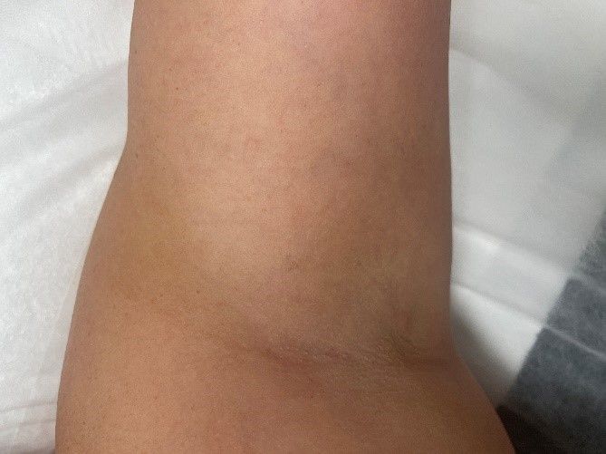 IPL Treatment 
