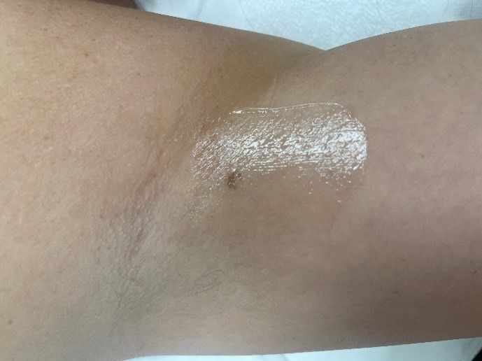 IPL Treatment 