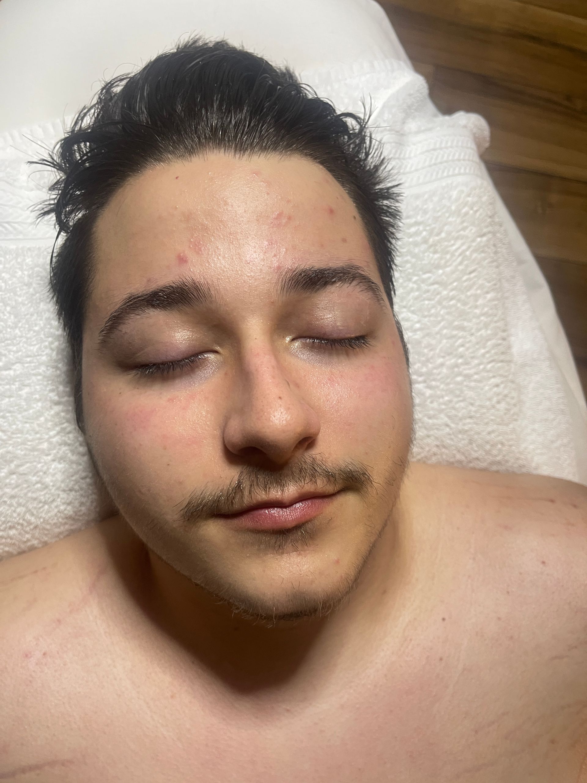 facial treatment