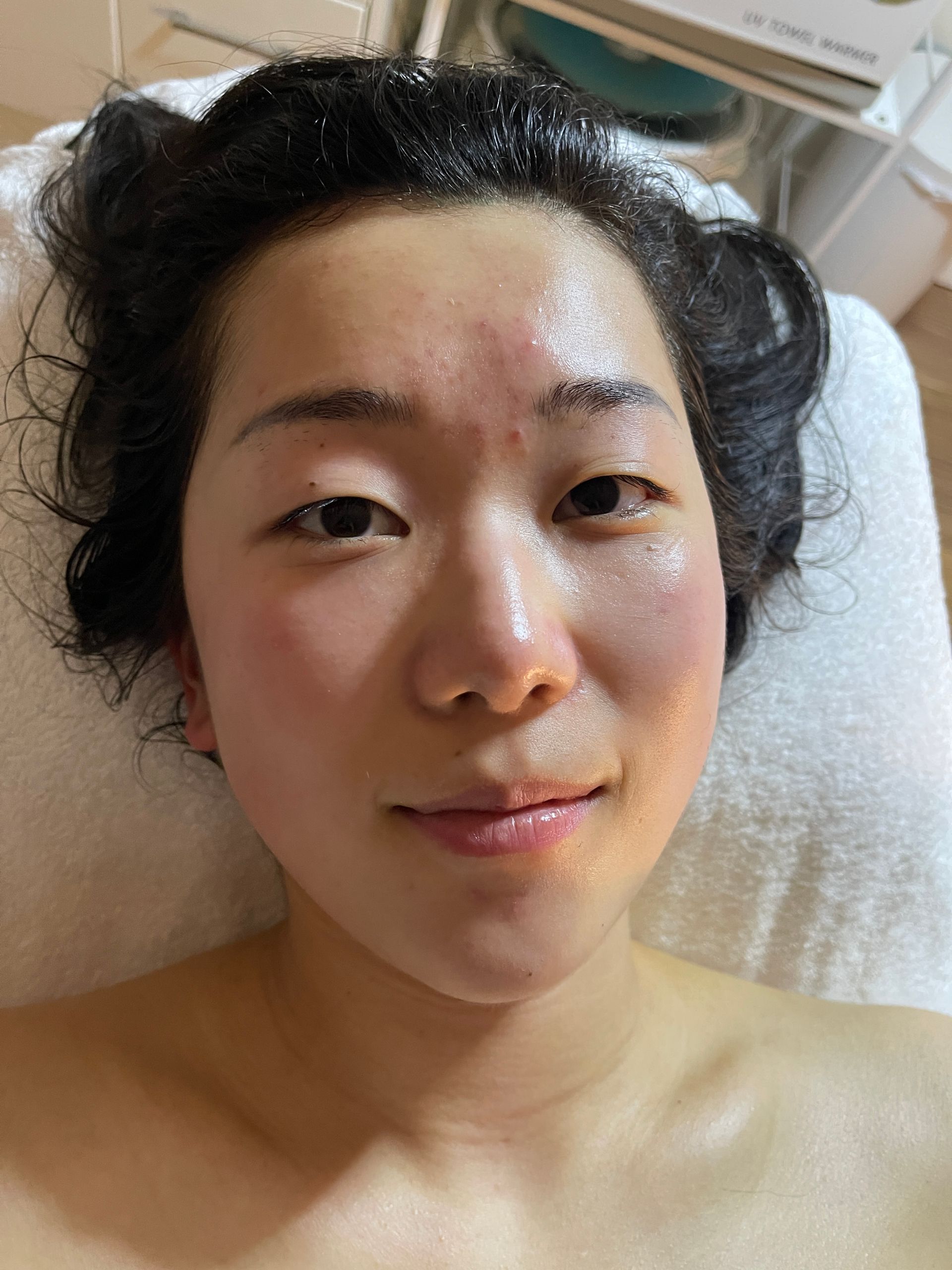 facial treatment