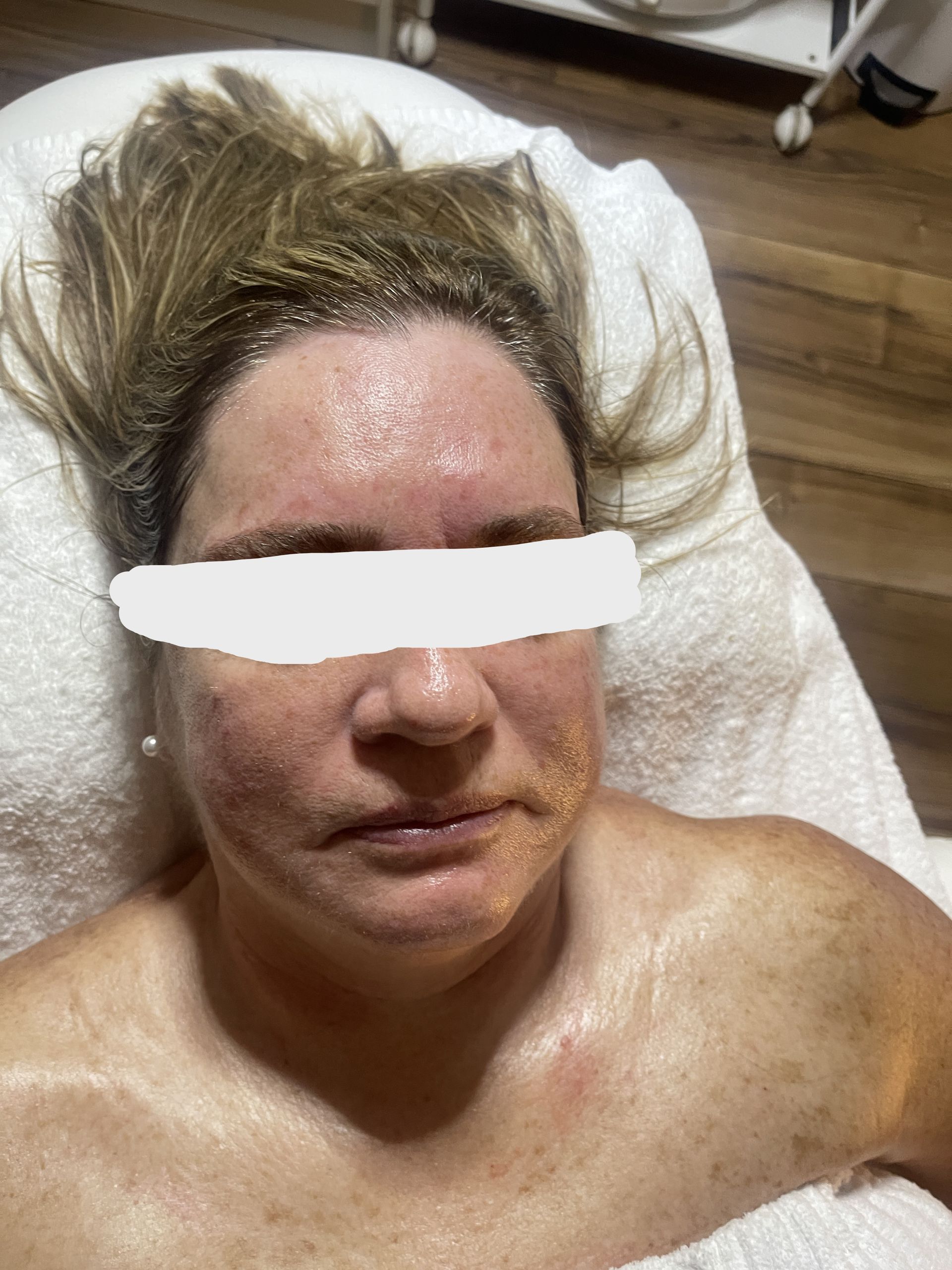facial treatment