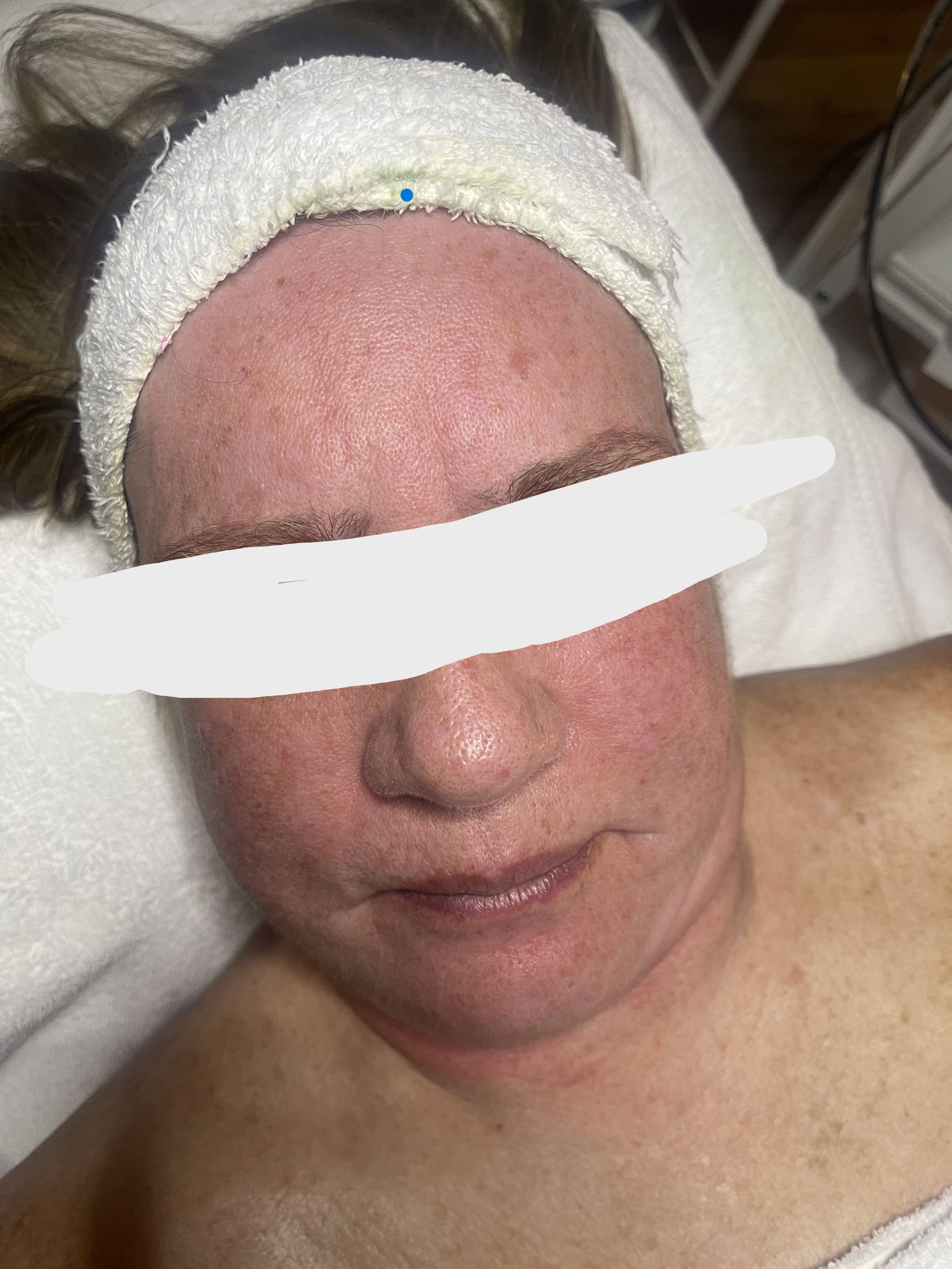 facial treatment