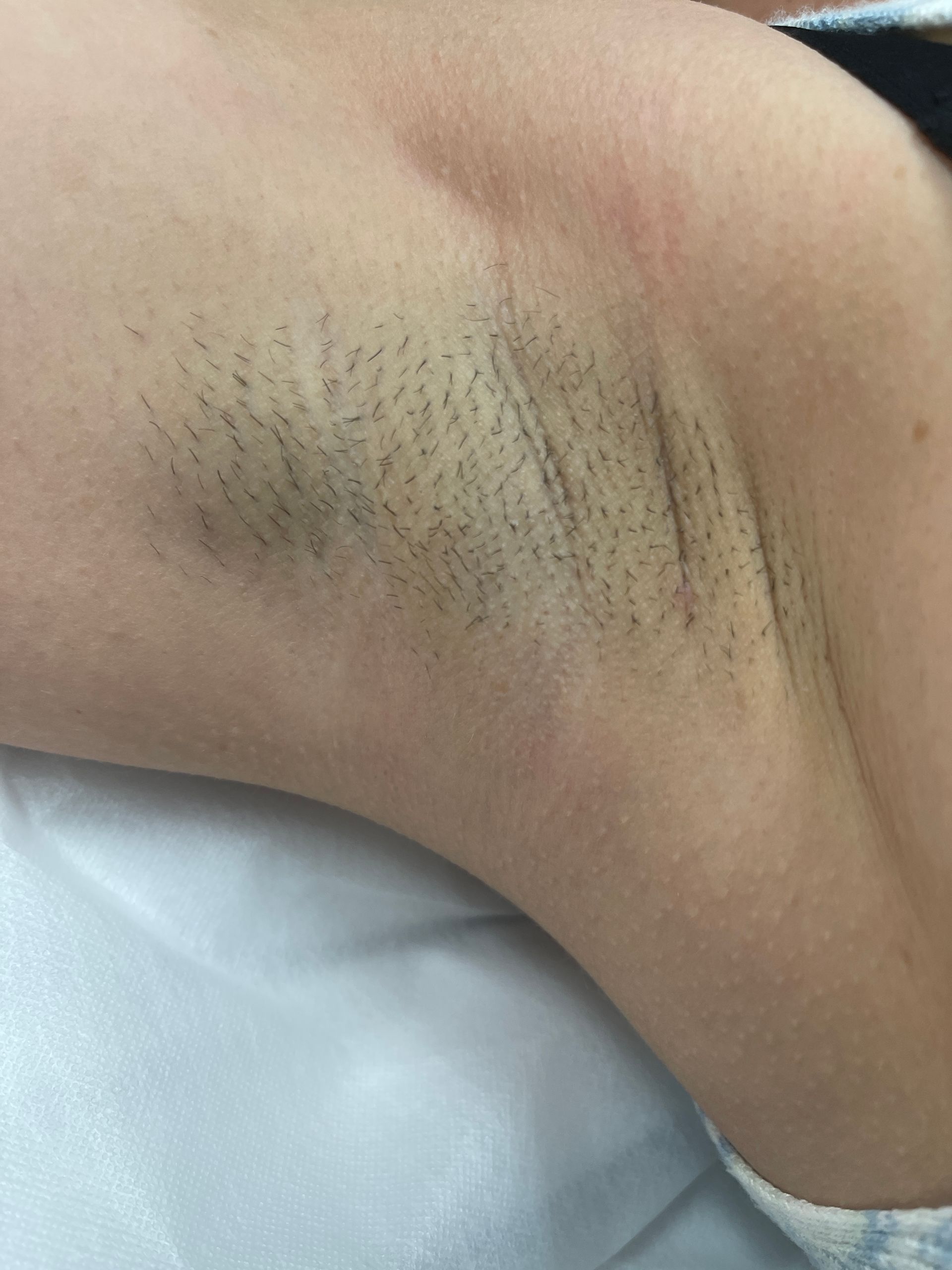 Laser body treatment