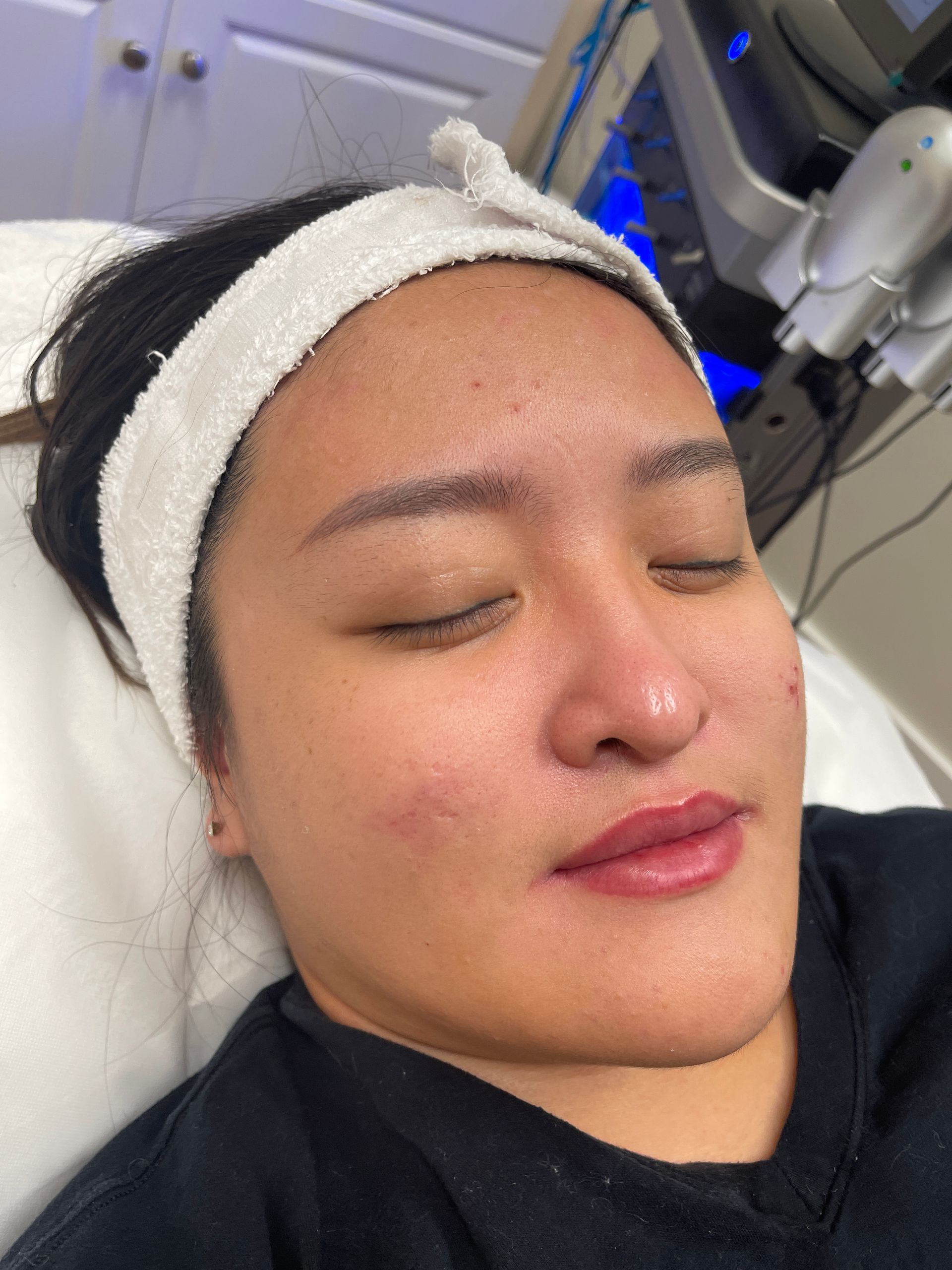 VIVA Nanofacial