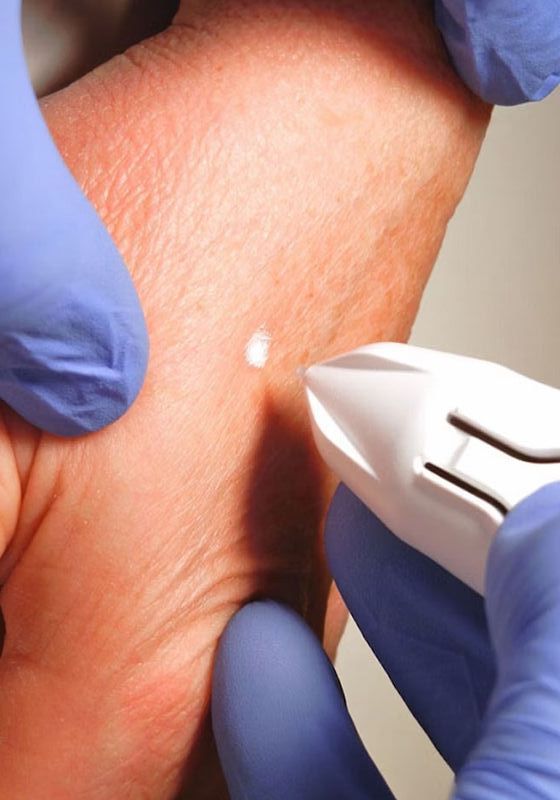 A person wearing blue gloves is removing an imperfection with CryoClear