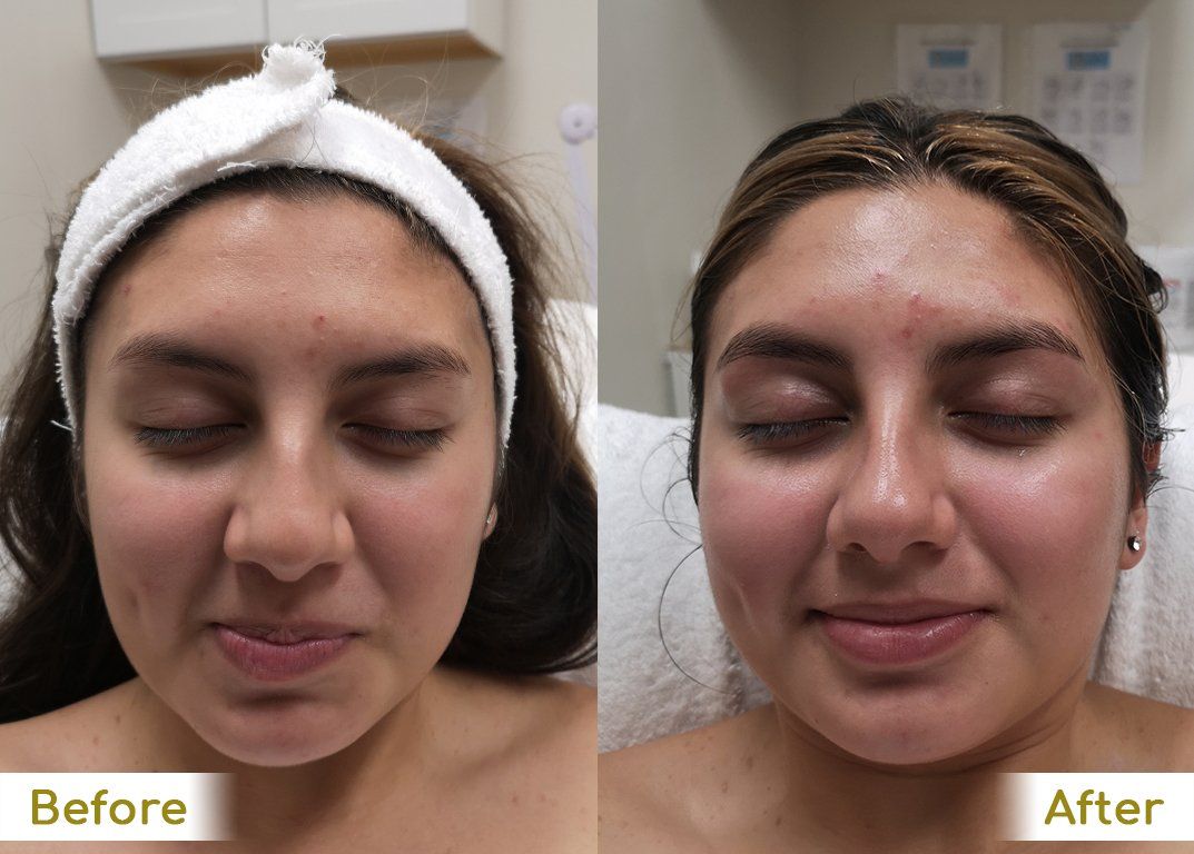 A before and after photo of a woman 's face