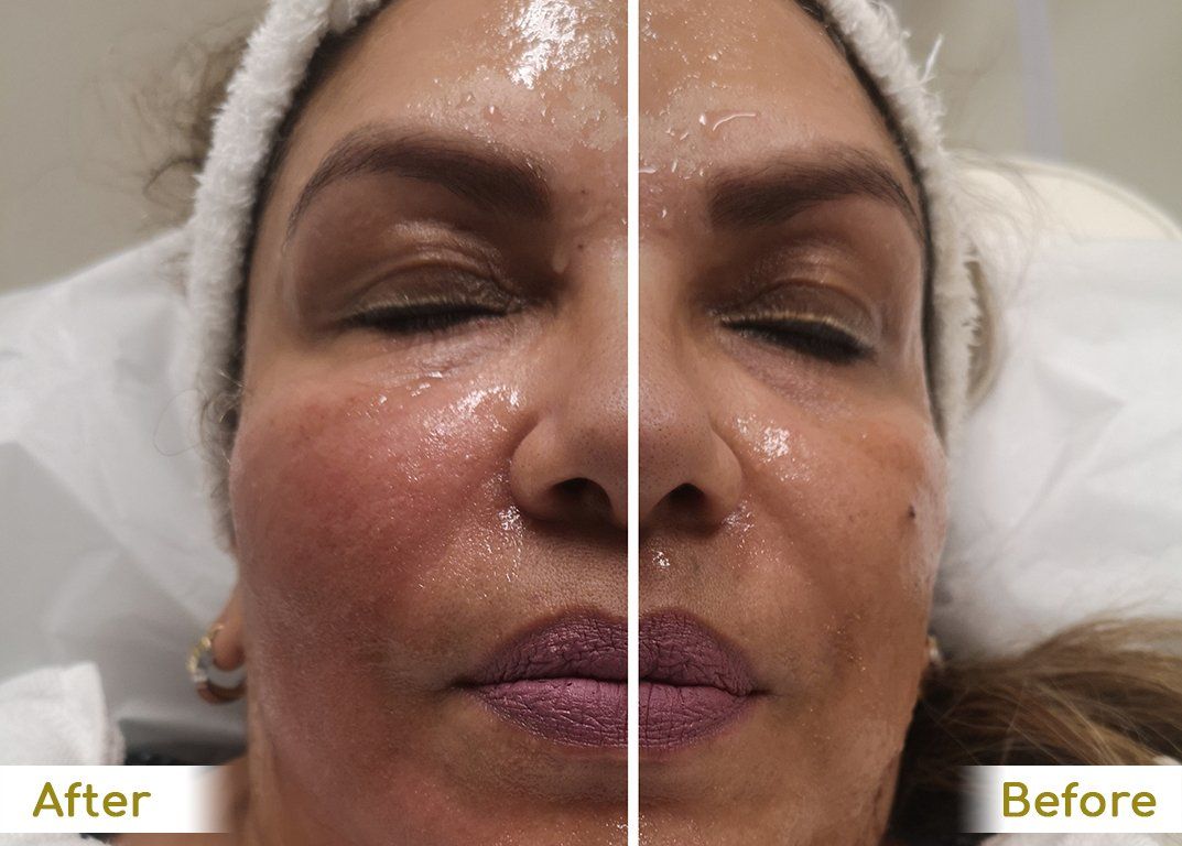 A before and after photo of a woman 's face.