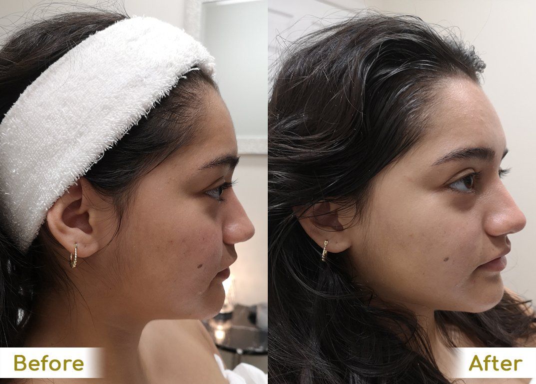 A before and after photo of a woman 's face
