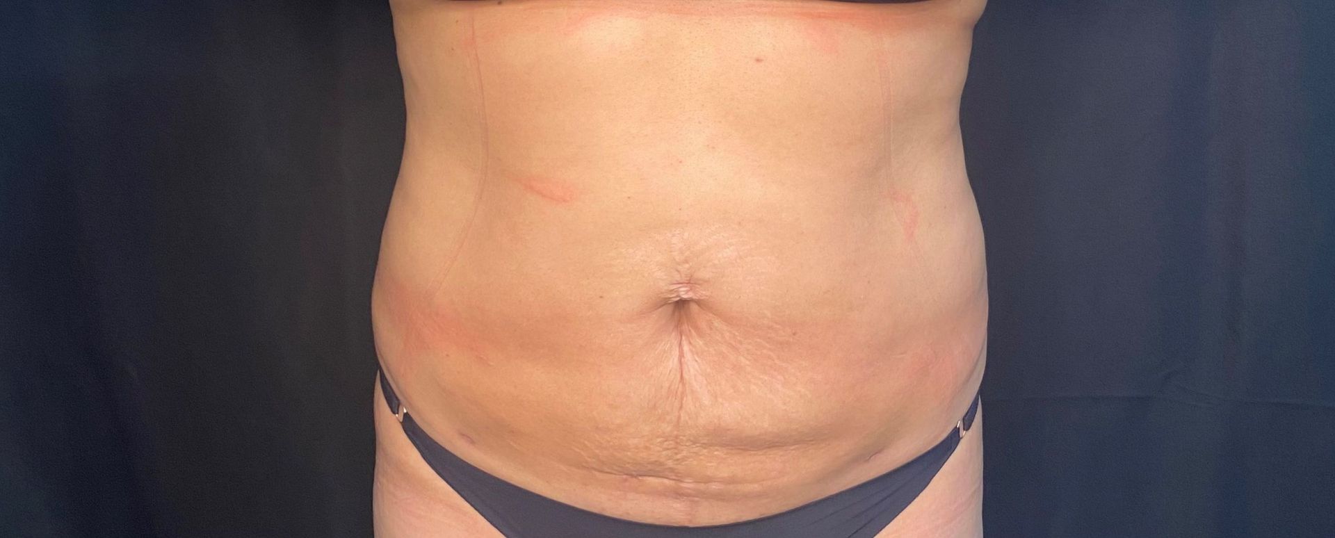 A woman's stomach is shown with a black background, after laser lipo treatment.