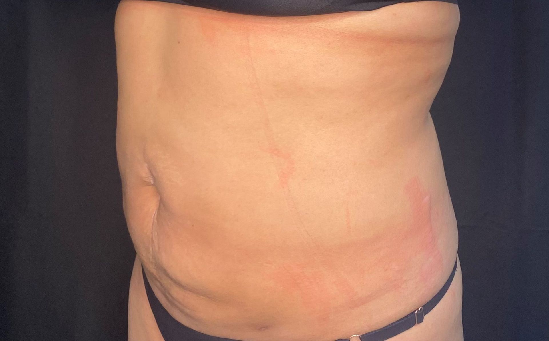 Side view of a woman's stomach is shown with a black background, after laser lipo treatment.